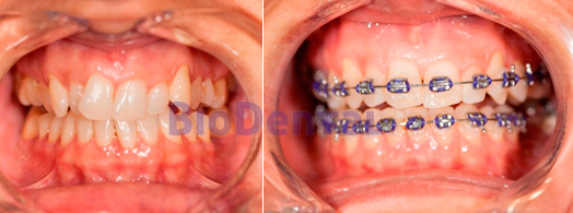 Ortodoncia convencional