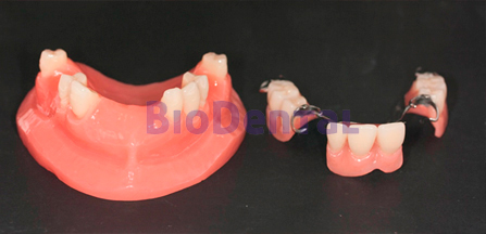 Tipo de prótesis dentales
